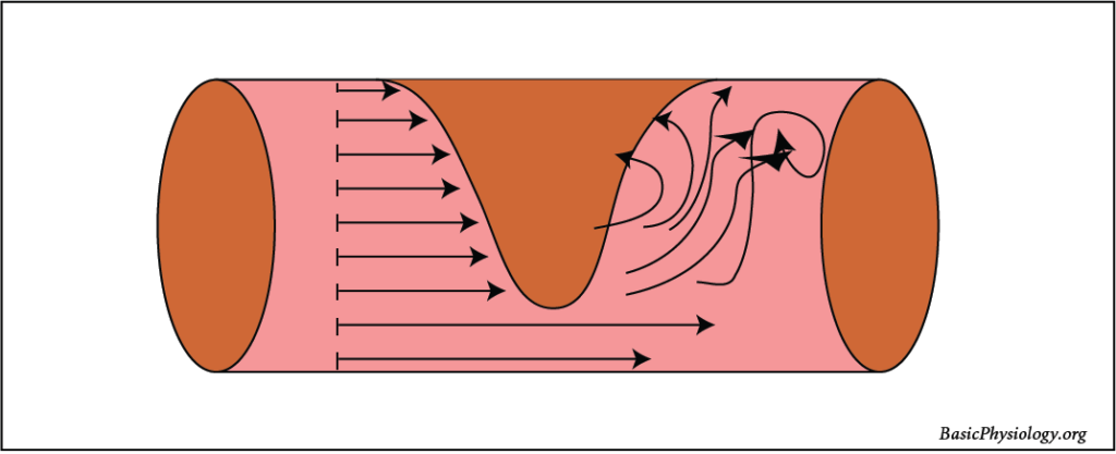 Diagram of turbulent blood flow through a blood vessel caused by an obstruction