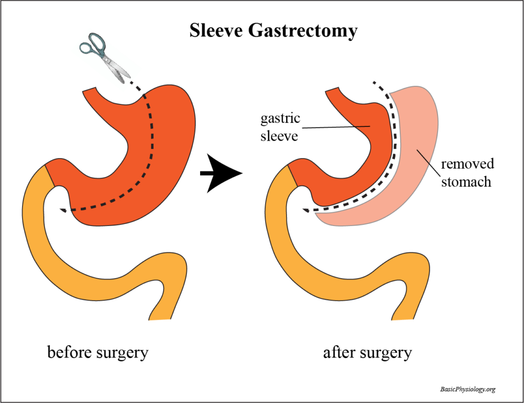 Diagram of sleeve gastrectomy used in obesity surgery