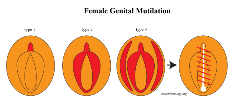 Diagram of several female genital mutilations