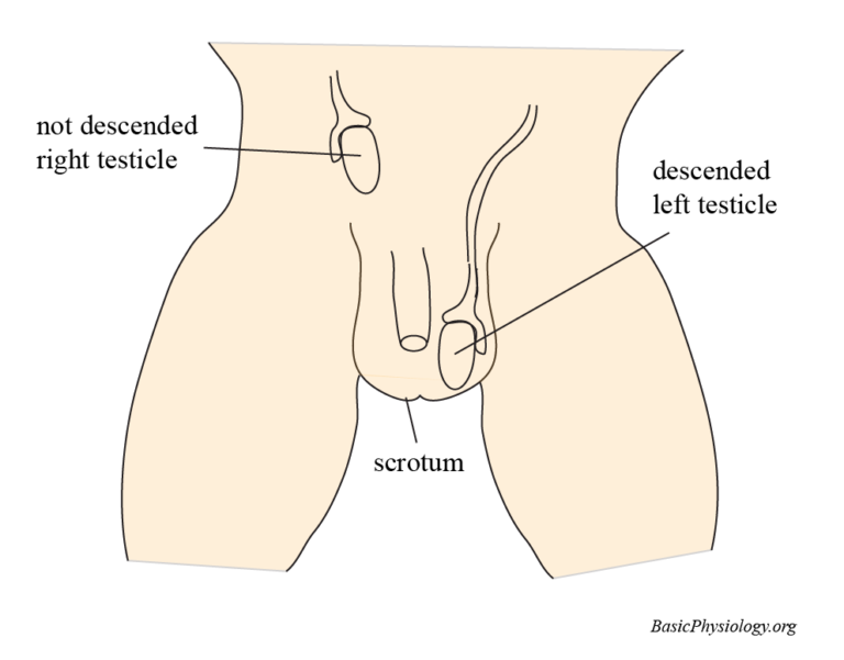 Diagram of a descended and a not descended testicle, leading to cryptorchidism