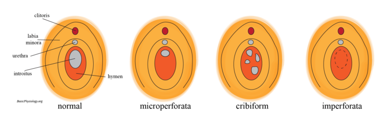 Different types of female hymen; from normal to microperforata, cribriform or imperforate