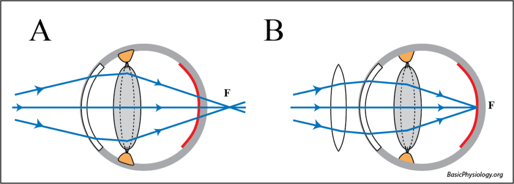 Presbyopia and the effect of reading lenses