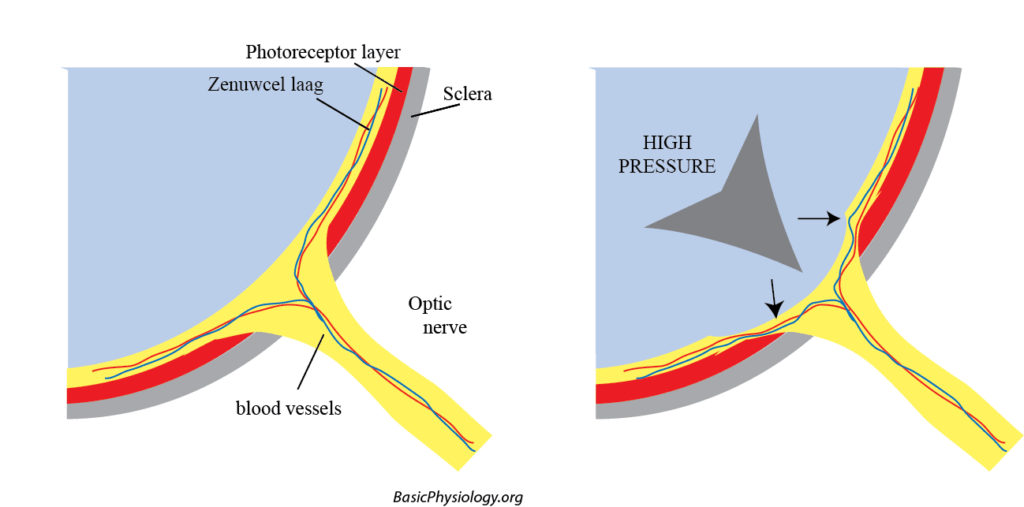 The effectsof glaucoma (= high intra-ocular pressure) in the optic nerves
