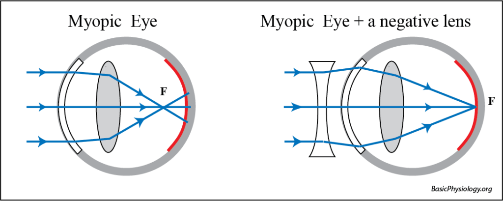 Diagram of a myopic eye with and without a concave lens